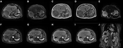 Case report: Hepatic inflammatory pseudotumor-like follicular dendritic cell sarcoma: A rare case and minireview of the literature